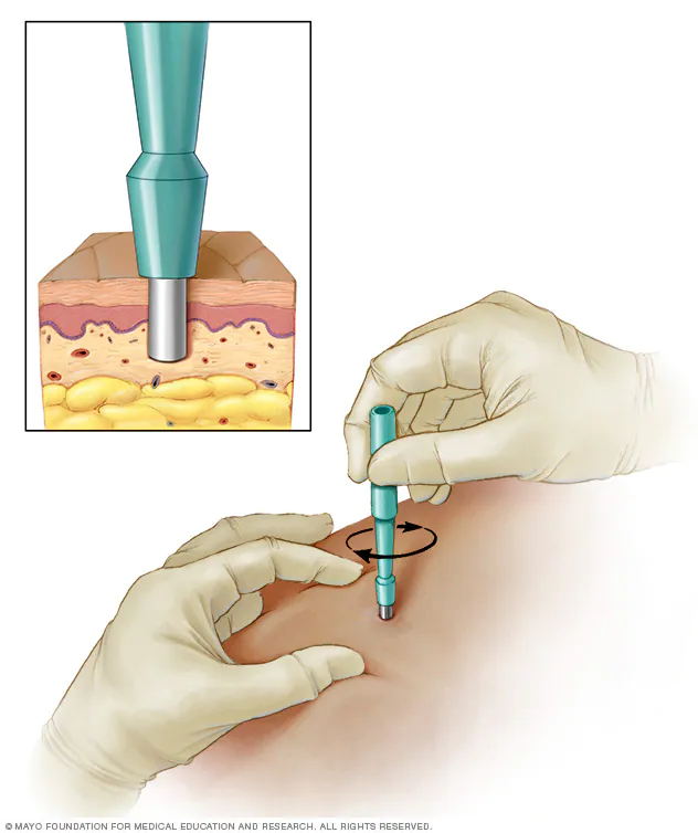 Biopsy Small